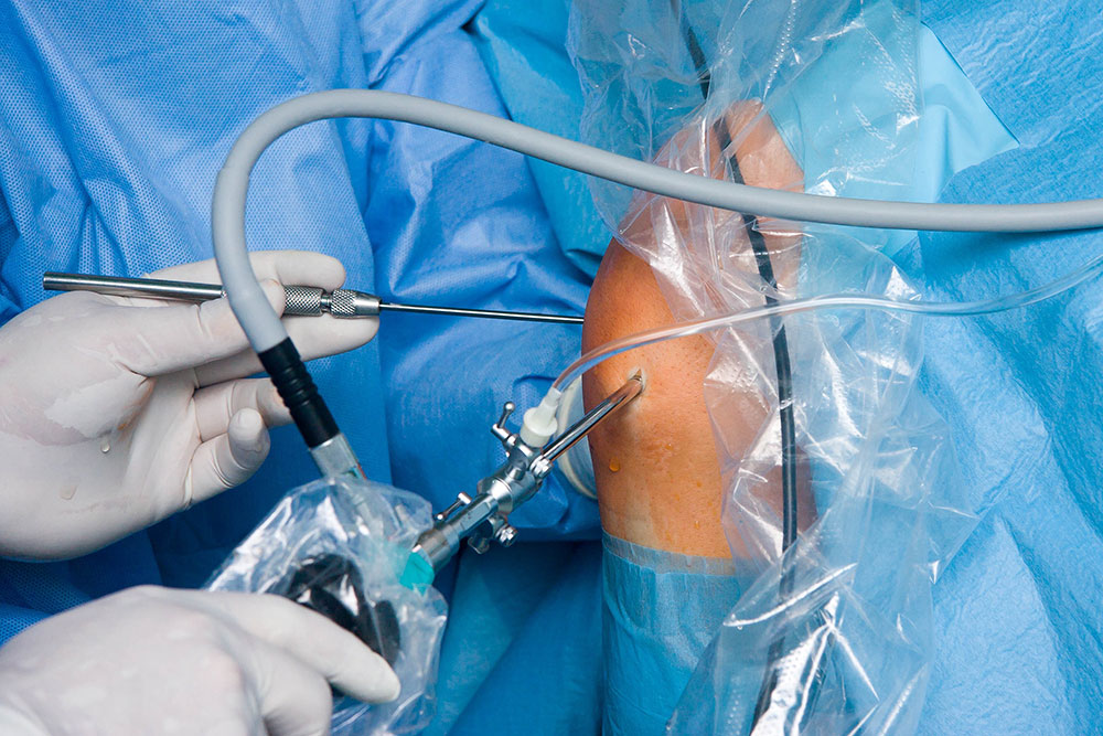 Артроскопия суставов в Клинике КОНСТАНТА в Вологде | Стоимость операции по  артроскопии